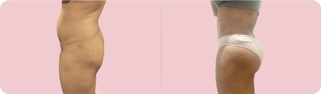 Buttock Reshaping 11