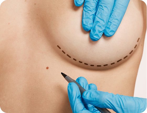 Breast Fat Injection