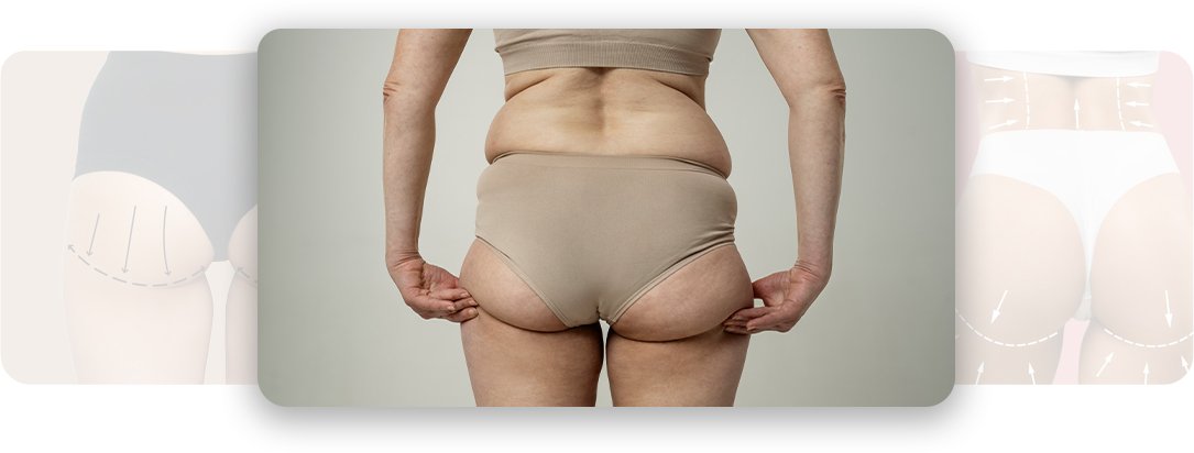 Buttock - AEONA Aesthetic Clinic