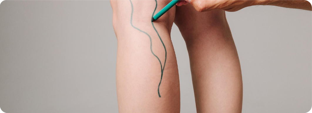 Calf Implant Procedures