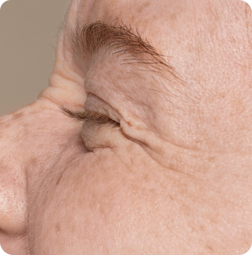 Why Women Choose Botox and Filler