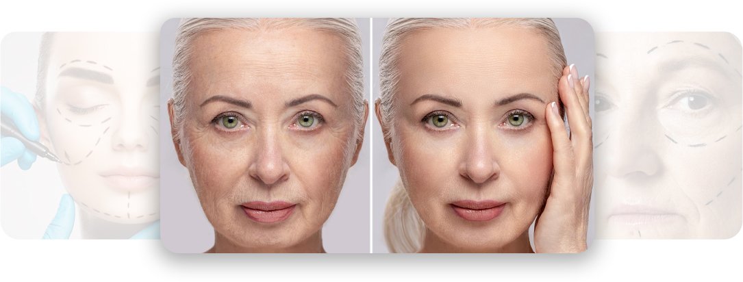Face Lift - AEONA Aesthetic Clinic