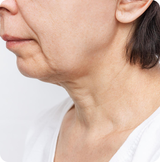 Why Women Choose Necklift