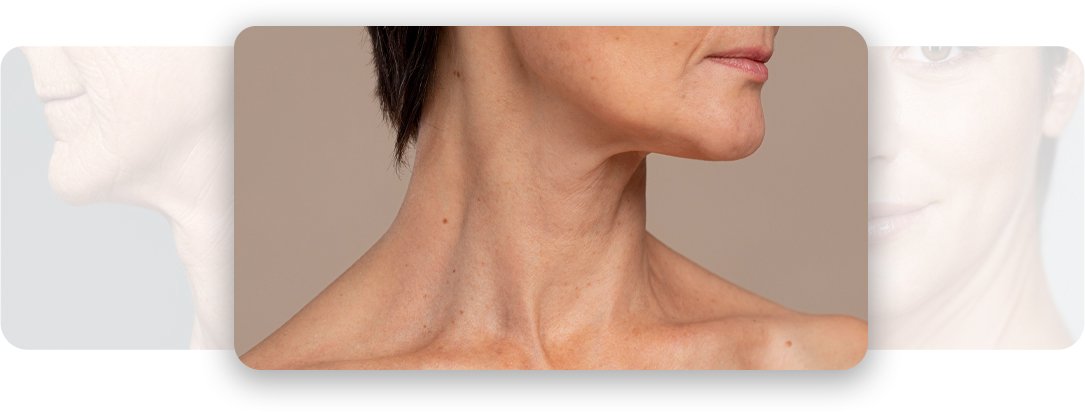 Neck Lift - AEONA Aesthetic Clinic