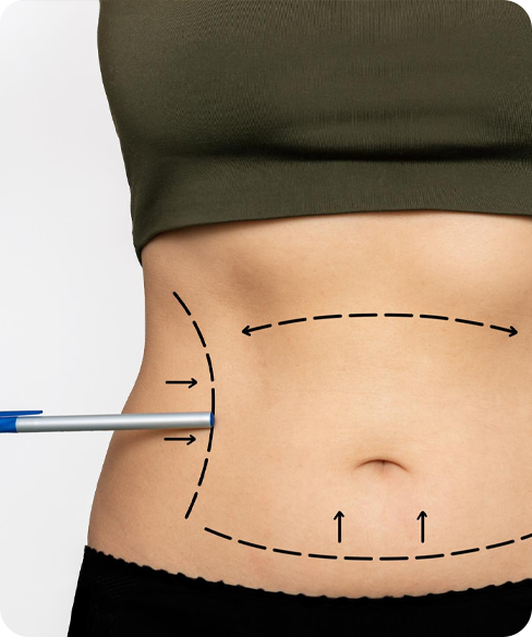 Liposuction