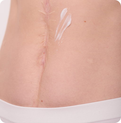 Why Women Choose Scar Revision?