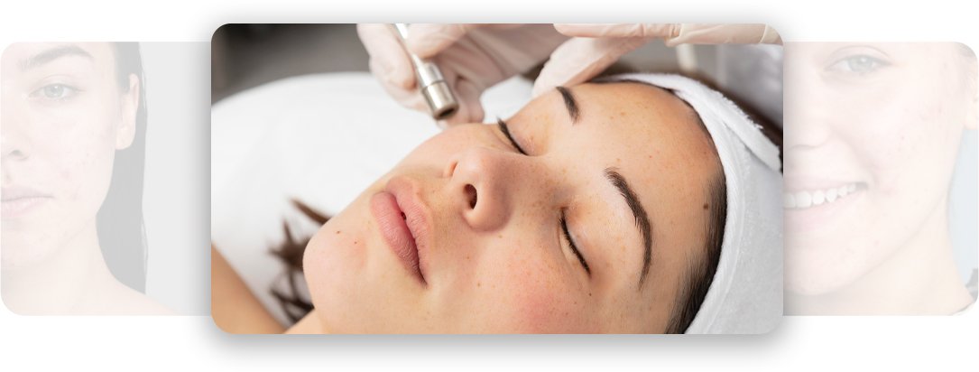 Microneedling - AEONA Aesthetic Clinic
