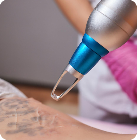 Why Women Choose Tattoo Removal?