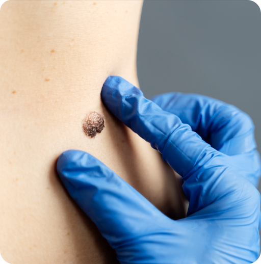 Why Women Choose Wart Removal?