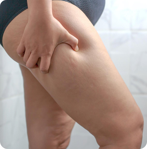 Why Women Choose Thighlift?