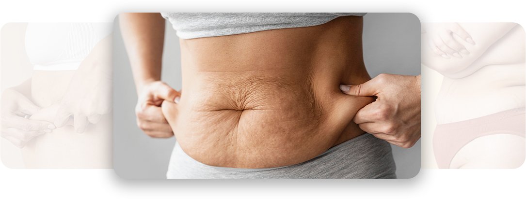 Post Weight loss Treatment - AEONA Aesthetic Clinic
