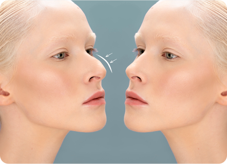 Rhinoplasty