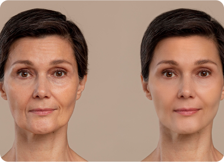 Facelift or Chin Augmentation