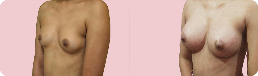 Meenakshi Before After